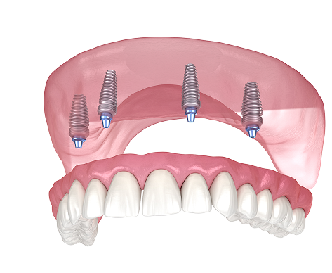 implant img